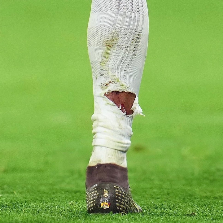塔蹬踏姆巴佩小腿染黄 赛后照片显示血痕与破损球袜